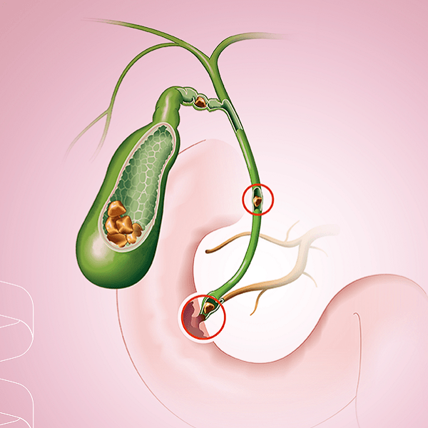 Coledocolitíase IECAD